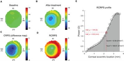 The Spatial Distribution of Relative Corneal Refractive Power Shift and Axial Growth in Myopic Children: Orthokeratology Versus Multifocal Contact Lens